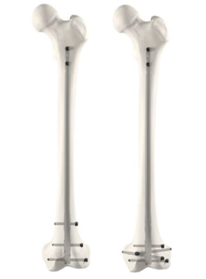 T2 Alpha Femur Retrograde