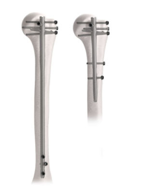 T2-Alpha-Humeral-Nails