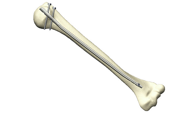 T2 Humeral Nailing System