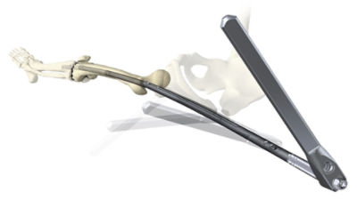 T2 Knee Arthrodesis | Stryker