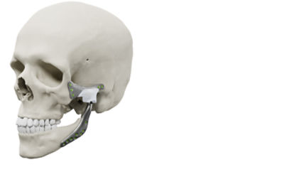 Crânio com implante TMJ Concepts
