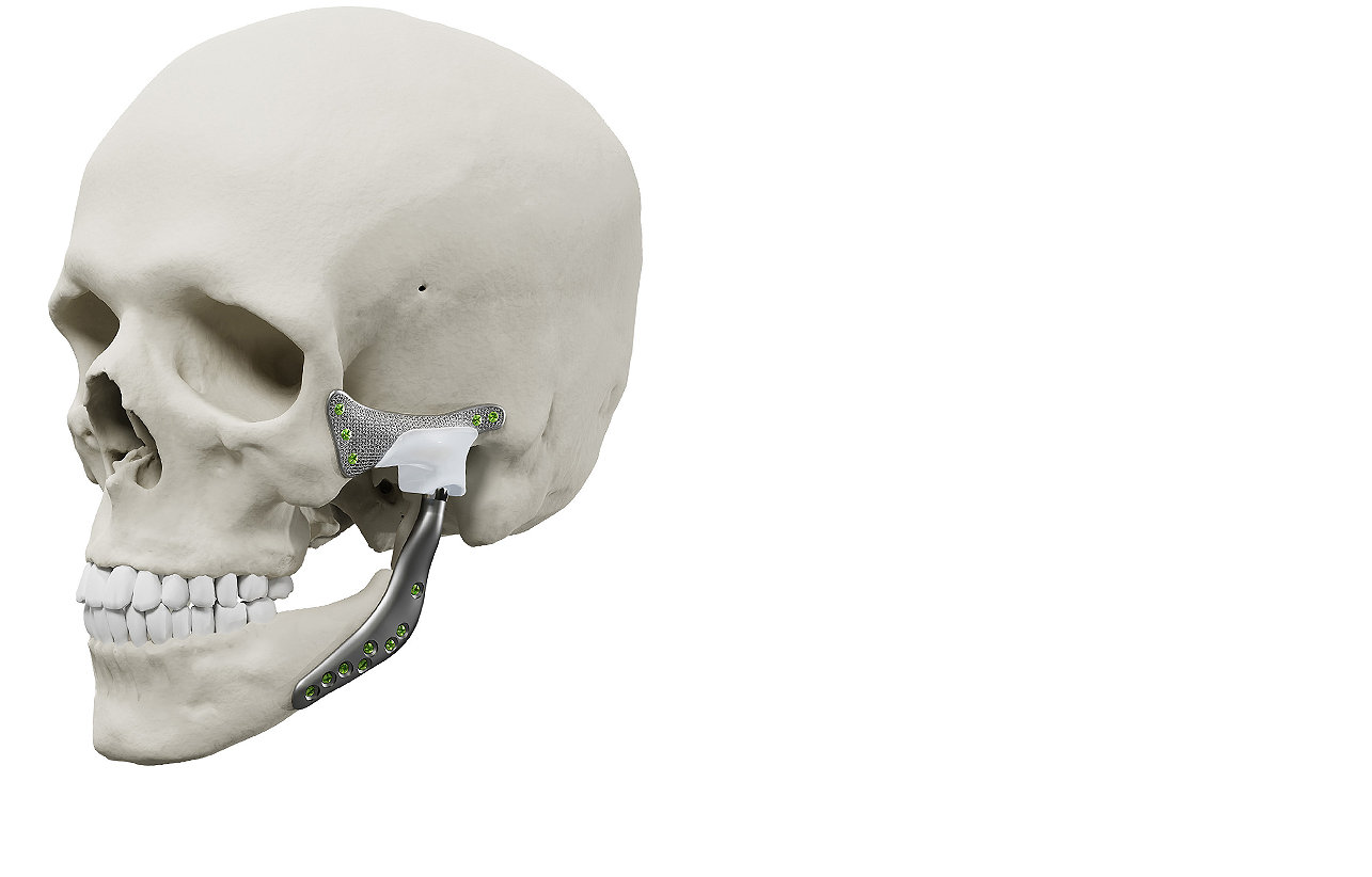 Kranie med TMJ Concepts-implantat