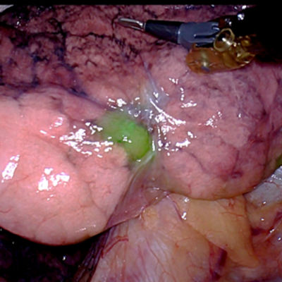 Thoracic-2