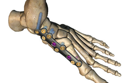 Salvation 3Di Plating System - Wright Medical Stryker