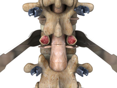 Osteotomy