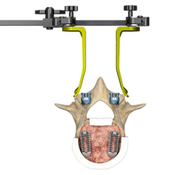 Xia CT (Cortical Trajectory)