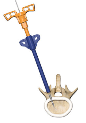 LITe Pedicle Access Solution