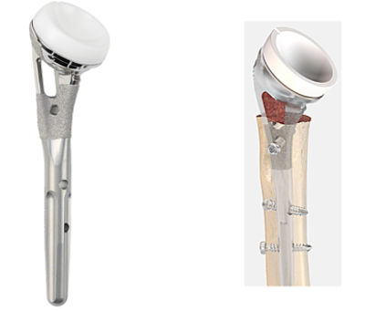 Tornier Perform Fracture (2)