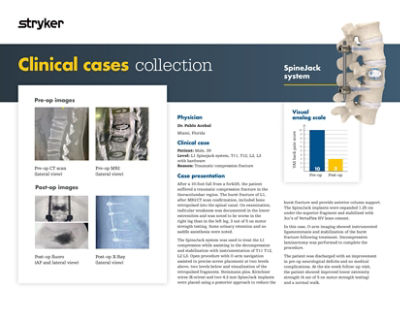 Clinical case demonstrating 39-year-old patient outcome with traumatic compression fracture using SpineJack system