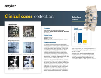 Clinical case demonstrating 71-year-old patient outcome with traumatic fracture using SpineJack