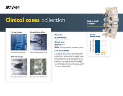 Clinical case demonstrating 27-year-old patient outcome with traumatic vertebral compression fracture using SpineJack system