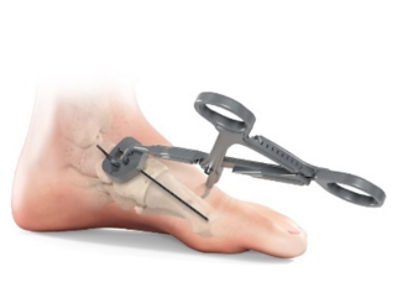 TruAim Lisfranc Product Image