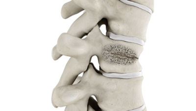 Vertebral augmentation may help patients suffering from vertebral compression fractures