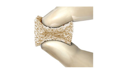 Vesuvius Demineralized Sponge