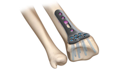 VariAx 2 Distal Radius Locking Plate System