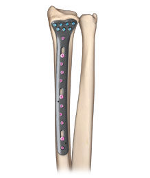 VariAx 2 Distal Radius XXL Plate