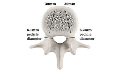 Vertebral body height for SpineJack procedure