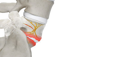 Vertebrogenic low-back pain is a chronic pain originating from the vertebrae, specifically due to damaged endplates