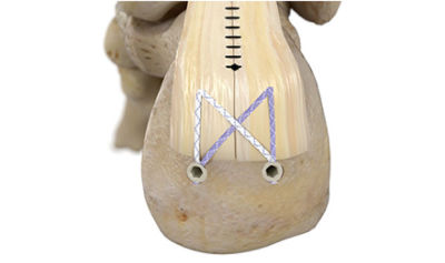 achilles-tendon-repair