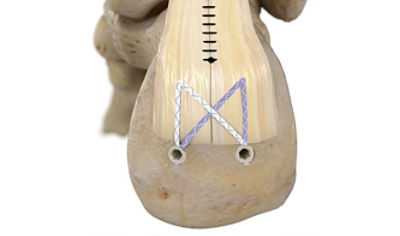 achilles-tendon-repair-thumbnail