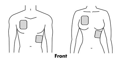 Anterior-lateral placement of AED pads