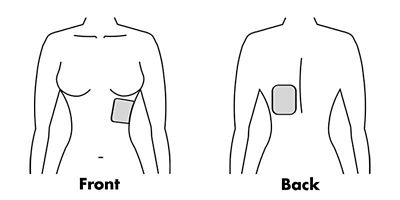 Anterior-posterior placement of AED pads