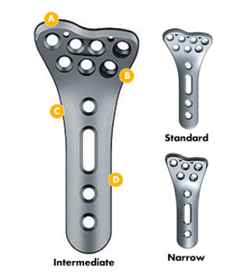 Anatomic Volar Plates