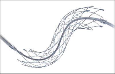 angioplasty and stenting image