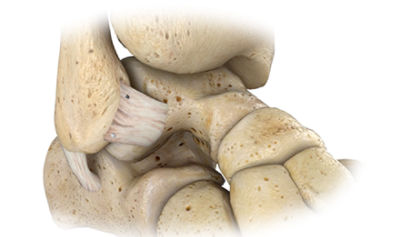 ankle-instability-CTA-thumb