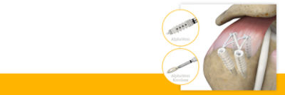 AlphaVent and AlphaVent Knotless products 