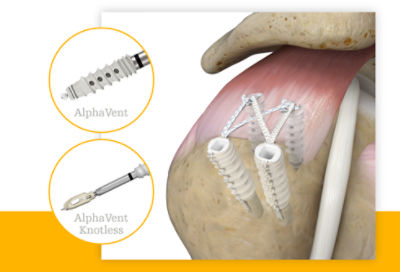 AlphaVent and AlphaVent Knotless products 