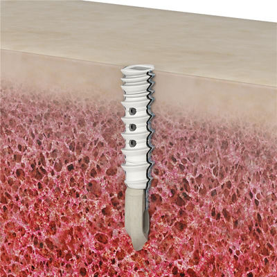 AlphaVent dual-thread technology