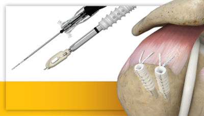 AlphaVent Knotless Biocomposite product