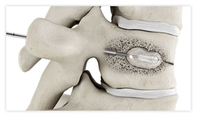 A balloon being inserted through a needle into a fractured vertebra, where the balloon is inflated to create space and restore the vertebra’s height