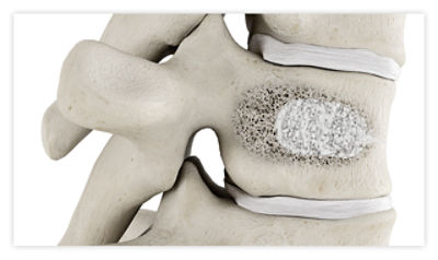 A spine after balloon kyphoplasty, where the treated vertebra is stabilized with bone cement, reducing pain and restoring height
