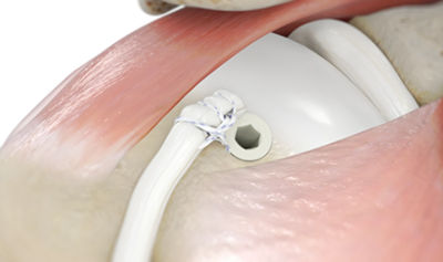 bicep-tenodesis-CTA-thumb