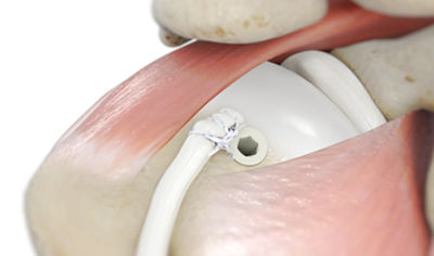 bicep tenodesis procedural thumbnail