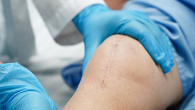 Infection-free incision scar on knee