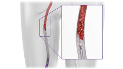 ClotTriever in anatomy