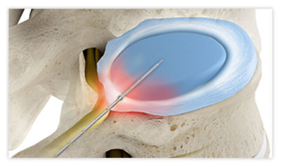 A disc decompression treatment being performed on a herniated disc, using minimally invasive techniques