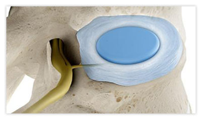 Step 3: Decompressed disc relieves pain within a week of the procedure