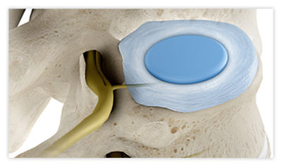 A spine after disc decompression, with the pressure on the nerves relieved