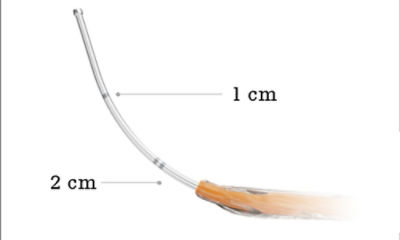 distal markers for XpreESS ENT dilation system