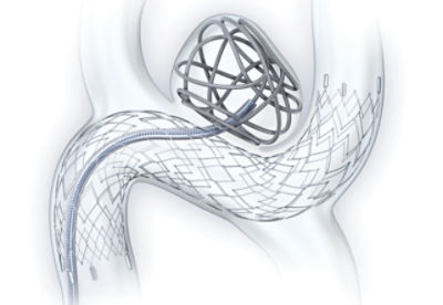 Effectively treat anterior and posterior aneurysms