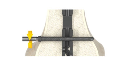 features-advanced locking screw 2