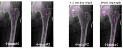 Total Hip replacement(posterior approach): Exeter femoral stem and  Tritanium acetabular component (Stryker) Surgical Technique - OrthOracle