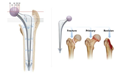 Total Hip replacement(posterior approach): Exeter femoral stem and  Tritanium acetabular component (Stryker) Surgical Technique - OrthOracle