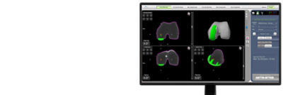 Mako Partial Knee planning screen