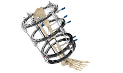 Bone Transport Product Image