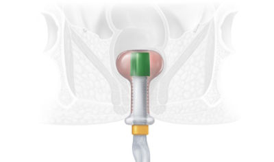 Stryker's hygh-tec fecal management system product visualization 
